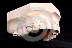 Denture