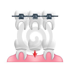 Denture concept - healthy teeth with a fixed dental bridgework and braces on top of them. Vector illustration of human teeth in a