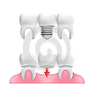 Denture concept - healthy teeth with fixed dental bridgework and implants. Vector illustration of human teeth in a 3d realistic