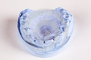 A denture gibs model