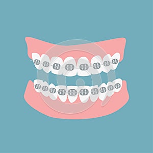 Denture icon gums with teeth and braces isolated on green background. Alignment teeth process.