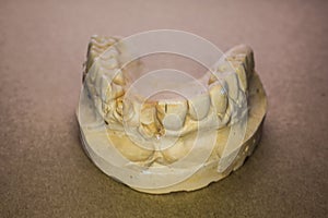 Denture impression made of plaster with implants