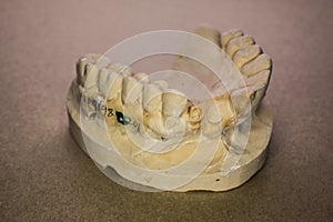 Denture impression made of plaster with implants