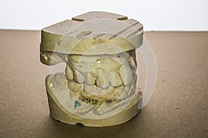 Denture impression made of plaster with implants