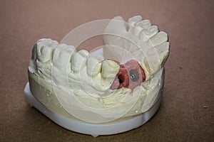 Denture impression made of plaster with implants
