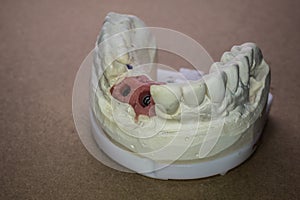 Denture impression made of plaster with implants