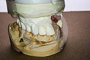 Denture impression made of plaster with implants