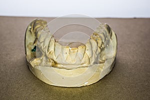 Denture impression made of plaster with implants