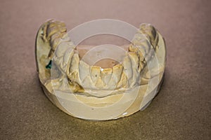 Denture impression made of plaster with implants