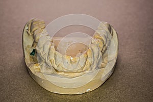 Denture impression made of plaster with implants