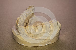 Denture impression made of plaster with implants