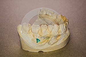 Denture impression made of plaster with implants