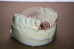 Denture impression made of plaster with implants