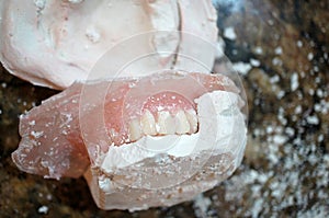 Denture Making Process of Removing From the Mold