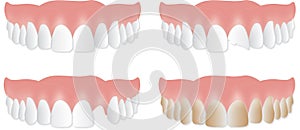 Denture upper plate. Broken, chipped, stained teeth