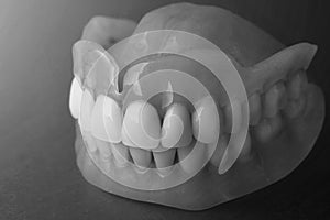 dentures. Isolate on white background acrylic prosthesis of human jaws. The concept of orthopedic dentistry
