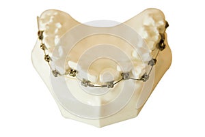 Dentures, orthodontic wire