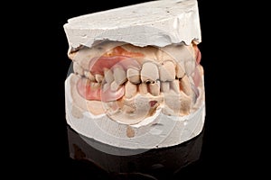 Dentures on a plaster cast