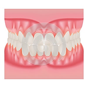 Dentures With White Teeth, Dentition The Gums Of The Upper And Lower Jaw, The Bite In Occlusion Isolated On A White Background. Ve
