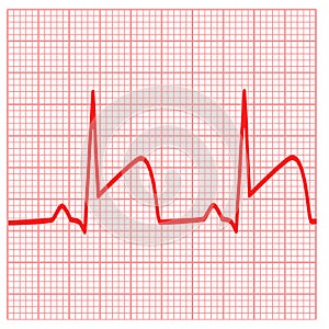 Depicts ECGs for myocardial infarction. Heart attack sign. coronary artery thrombosis symbol. flat style