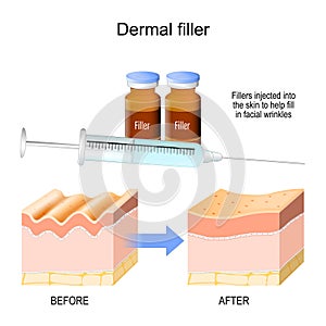 Dermal filler. Fillers injected into the skin to help fill in facial wrinkles