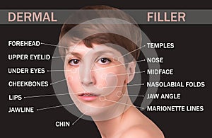 dermal filler treatments in your 40s .Hyaluronic acid injections for specific areas.Correct wrinkles