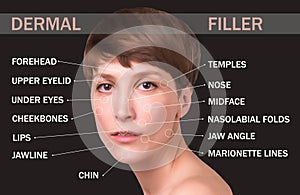 dermal filler treatments in your 40s .Hyaluronic acid injections for specific areas.Correct wrinkles photo