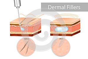 Dermal fillers or `soft-tissue fillers` photo
