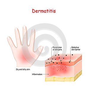 Dermatitis. Atopic eczema. Close-up of  Cross-section of human skin with dermatitis