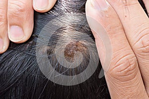 Dermatitis in hair or Skin disease on the head