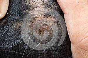 Dermatitis in hair or Skin disease on the head