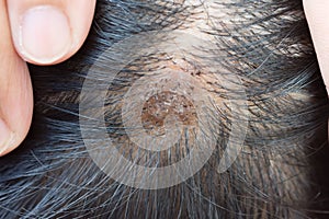 Dermatitis in hair or Skin disease on the head