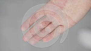 dermatitis hands palm skin itchy scratches on dry skin female hands, eczema