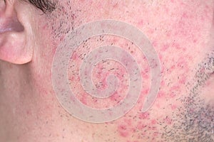 Dermatitis on man face. Eczema close up