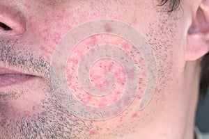 Dermatitis on man face. Eczema close up