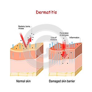 Dermatitis. Normal and skin with Damaged barrier. protection effect