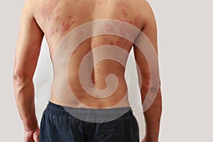 Dermatitis problem of rash ,Allergy rash