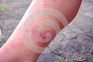 Dermatitis and vesicles, dermatitis from measles virus, dermatitis due to urticaria, health problems, allergies, redness on the le