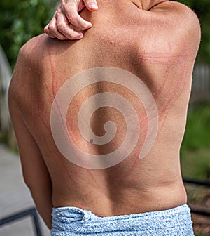 Dermatographic urticaria also known as dermographism, dermatographism or `skin writing`