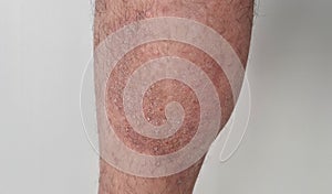 Dermatological skin disease and psoriasis on leg photo