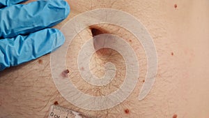 Dermatologist checking male birthmarks with ruler. Doctor examining length and width of benign moles on man skin