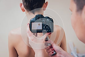 Dermatologist examines patient birthmark with dermatoscope and camera.