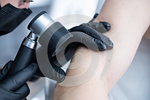 A dermatologist examines a patient's mole through a dermatoscope.