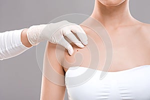Dermatologist examining birthmark on woman body, cropped photo