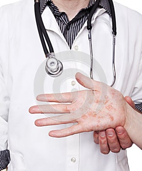 Dermatologist examining hand with severe eczema