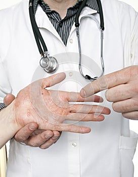 Dermatologist examining hand with severe eczema photo