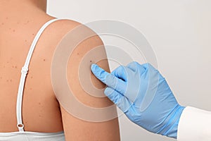 Dermatologist examining patient's birthmark on beige background, closeup