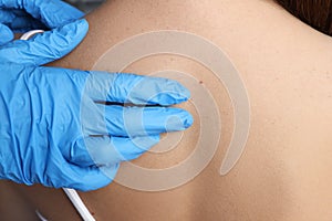 Dermatologist examining patient's birthmark in clinic, closeup