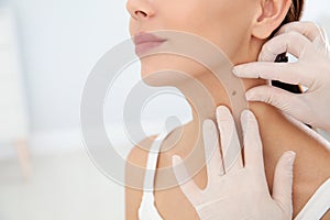 Dermatologist examining patient`s birthmark in clinic, closeup. photo