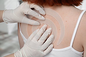 Dermatologist examining patient`s birthmark in clinic, closeup view